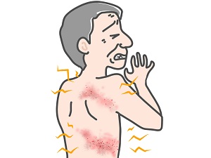帯状疱疹 帯状疱疹
