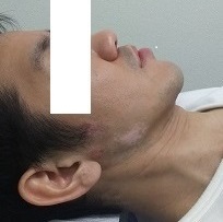 1年10か月後の白斑 1年10か月後の白斑