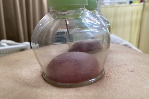 鍼治療 鍼治療