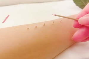 鍼灸治療 鍼灸治療
